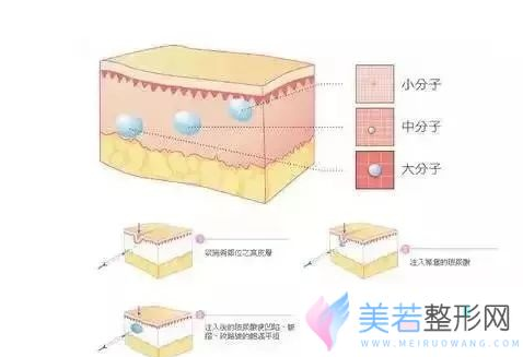 玻尿酸丰太阳穴