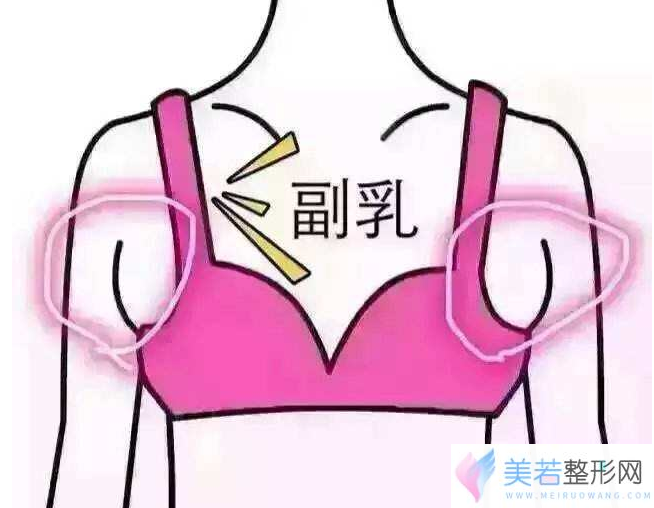 切除副乳