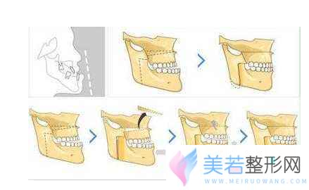 正颌手术