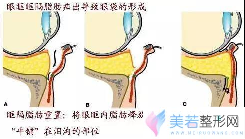 眶隔释放