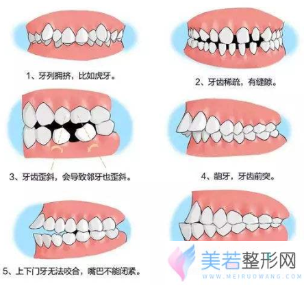 牙齿矫正