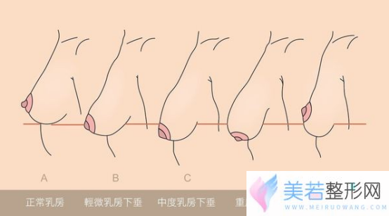 自体脂肪隆胸