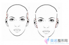 真性颧骨高和假性颧骨高有哪些区别呢？