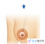 乳头凹陷该怎么办呢？