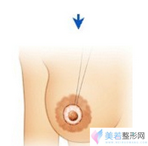 乳头凹陷