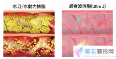 水动力吸脂与超音波溶脂有哪些区别呢？