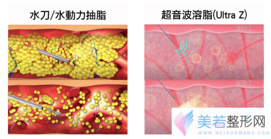 吸脂