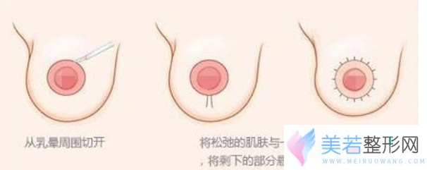 双环法乳房悬吊术