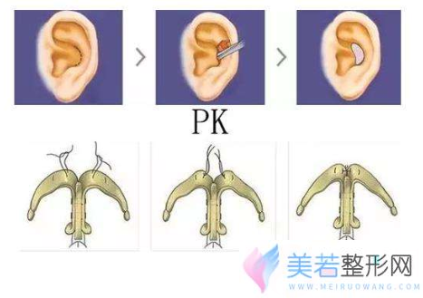 自体耳软骨隆鼻