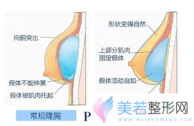 双平面隆胸