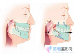 正颌和正畸有什么区别吗?