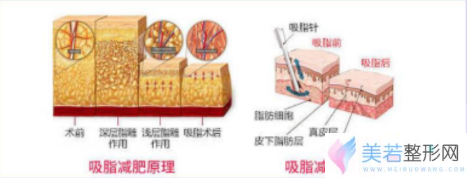 水动力抽脂