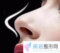 如何缩小鼻翼 深圳米兰柏羽整形医院“美鼻”攻略