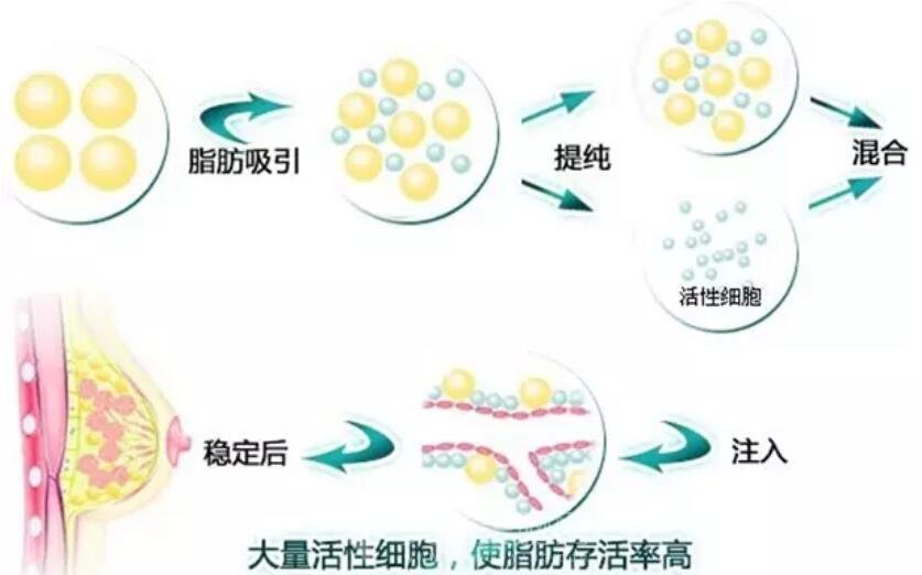 自体脂肪隆胸优点有哪些 是怎么做的