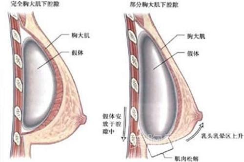 假体隆胸能保持多久？果维持的时间长吗？