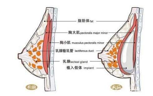 隆胸假体取出的危害和风险性大吗？