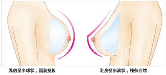 假体隆胸价格大概多少钱？隆胸价格和有什么有关？