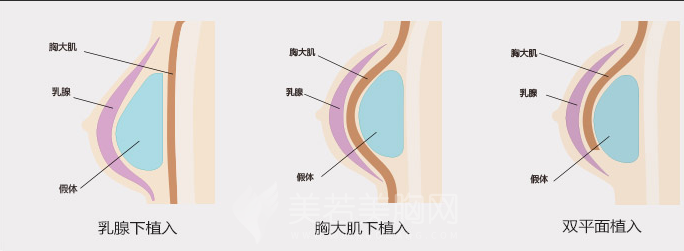 复合隆胸好不好？副作用大吗？