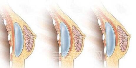 假体隆胸失败修复手术风险性及后遗症问题