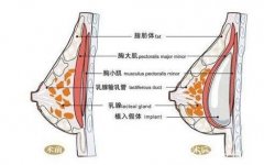 隆胸失败后怎么修复？修复方法全解析！