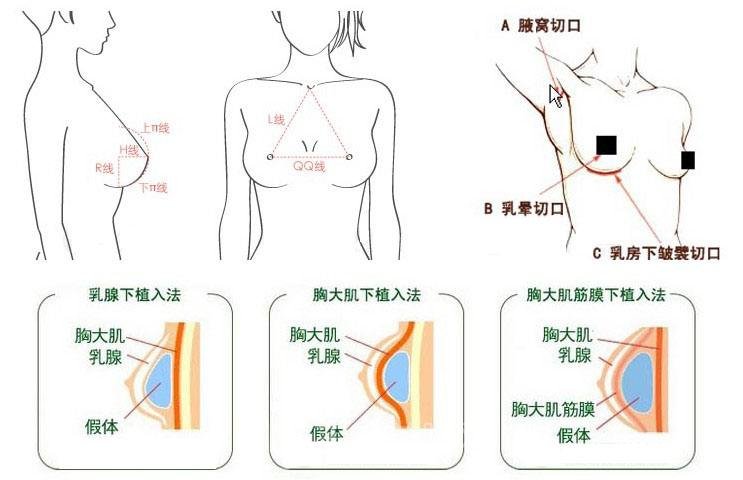 复合隆胸术术后会留疤吗？手术切口在哪里？