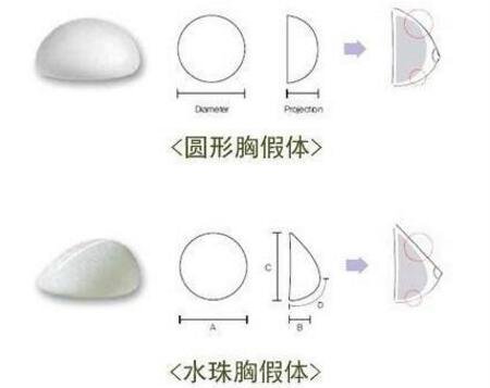 硅胶隆胸手术是怎么做的？手术大概流程