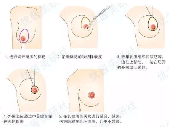 胸部下垂矫正步骤图