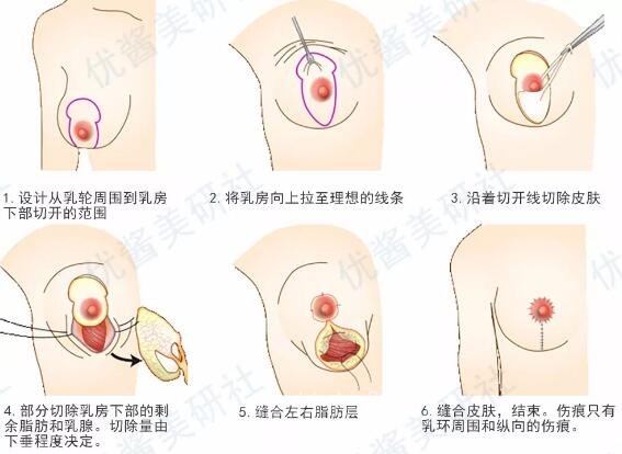 胸部下垂矫正示意图