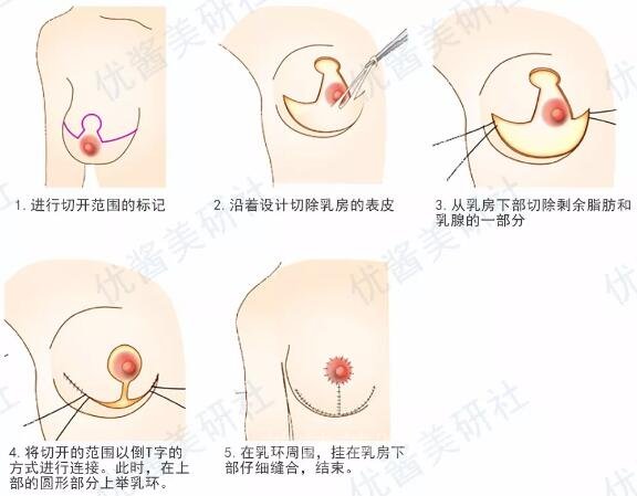 胸部重度下垂手术示意图