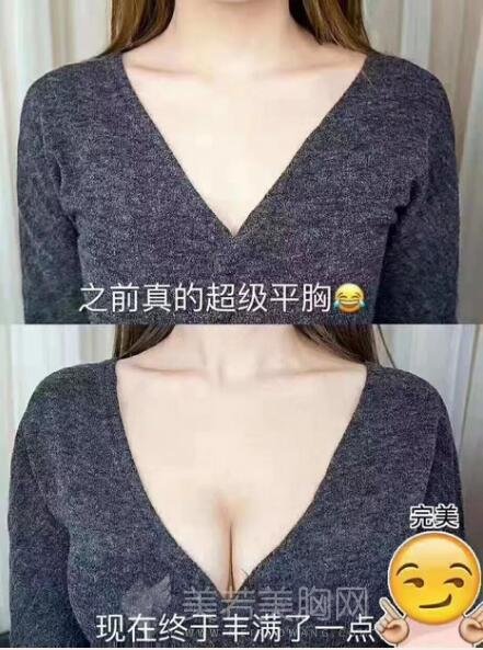 隆胸术后果图