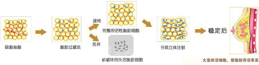 自体脂肪隆胸手术过程原来是这样的