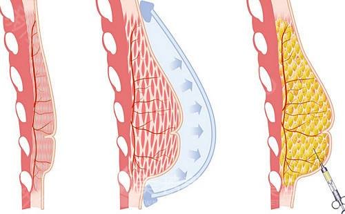 注射隆胸手术方法