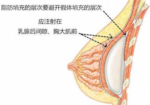 复合隆胸手术原理