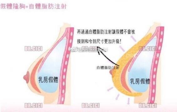 复合型隆胸果怎么样