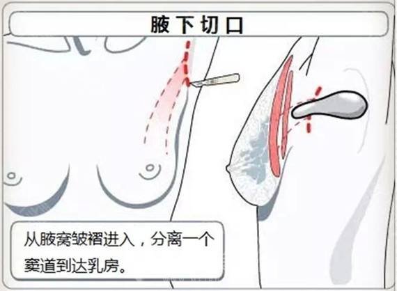 假体隆胸副作用竟然有这些，一文解析！