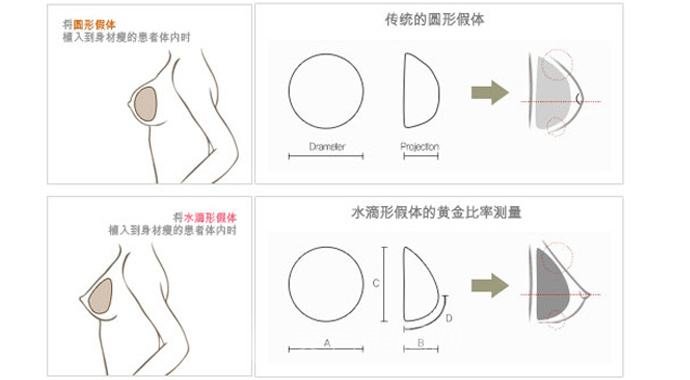 韩式假体隆胸手术的优势