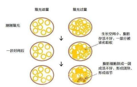 自体脂肪隆胸是不是可以一次成形?