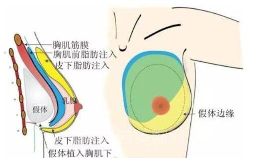 复合型假体丰胸会被抵触吗?没问题系数高吗?