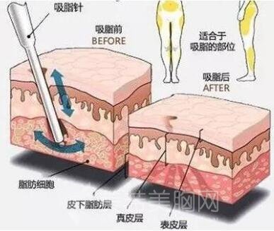 抽脂减肥副作用三：肌肤麻木，瘙痒，有点硬