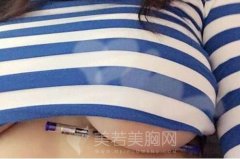 上海隆胸失败后的修复多少钱？上海地区收费详情!