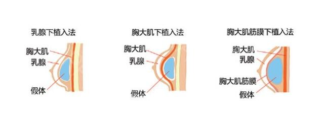 假体丰胸呢?