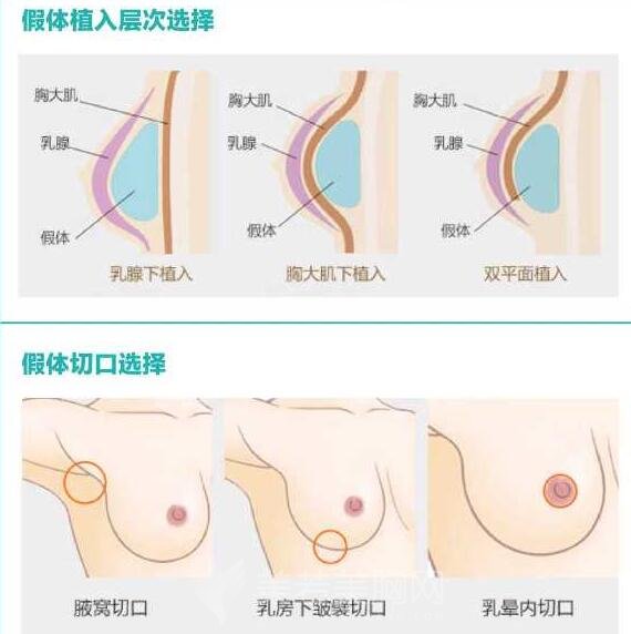 娜高假体丰胸手术后应当怎样护理?