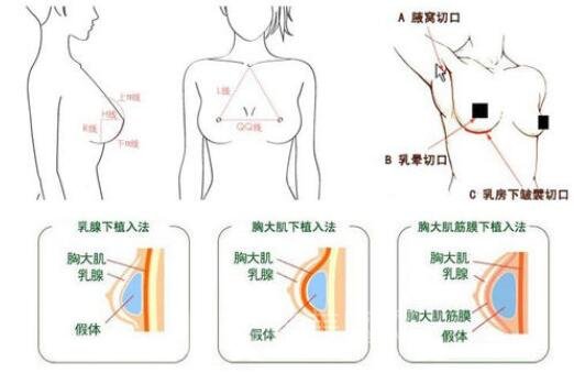 什么是微创假体隆胸?