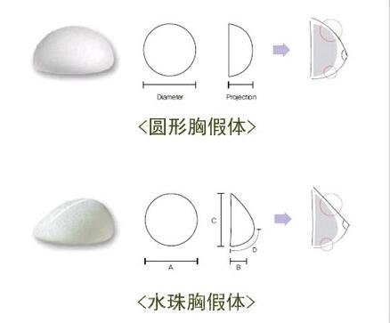 微创假体隆胸恢复恢复时间