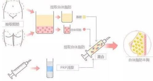 自体脂肪丰胸：原材料源自本身更没问题性