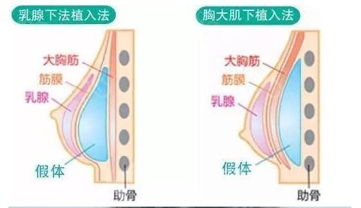 假体丰胸是否很风险?是否会出現排异反应状况呢?