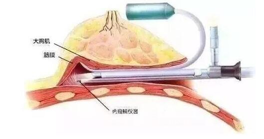 电子内窥镜假体丰胸手术基本原理