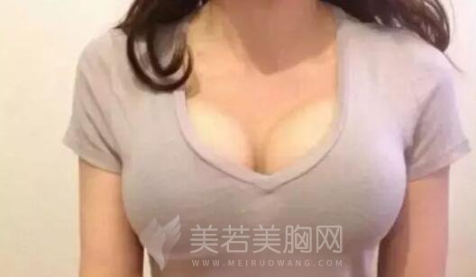 妙桃假体隆胸手术调节的实际果如何?