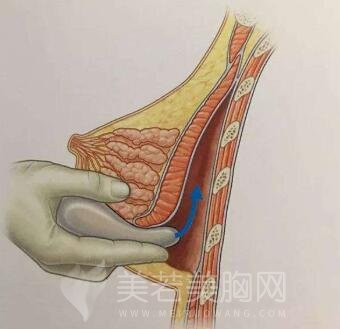 影响复合型隆胸手术果的因素有什么?