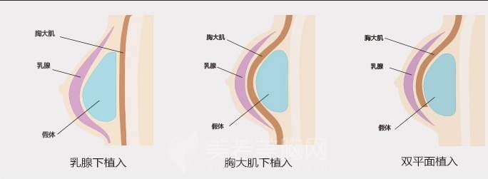 假体隆胸切口原来有这三个地方，你造吗？